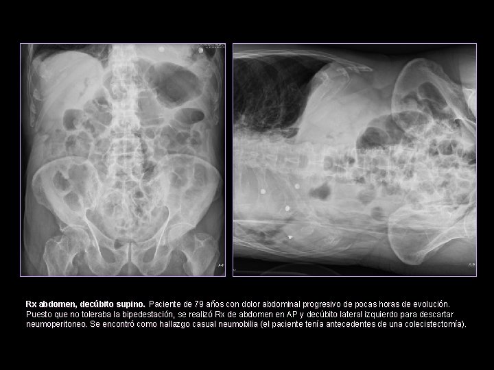 Rx abdomen, decúbito supino. Paciente de 79 años con dolor abdominal progresivo de pocas