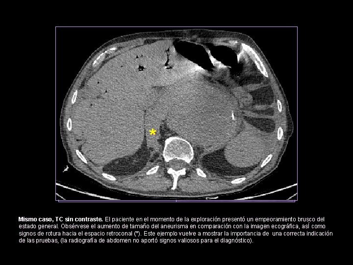 * Mismo caso, TC sin contraste. El paciente en el momento de la exploración