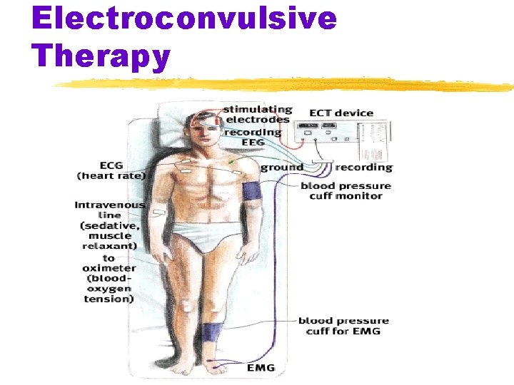 Electroconvulsive Therapy 