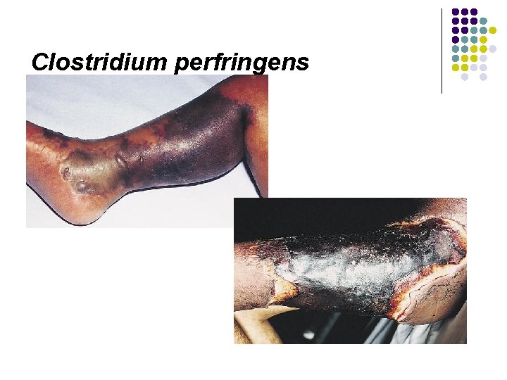 Clostridium perfringens 
