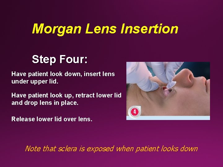 Morgan Lens Insertion Step Four: Have patient look down, insert lens under upper lid.