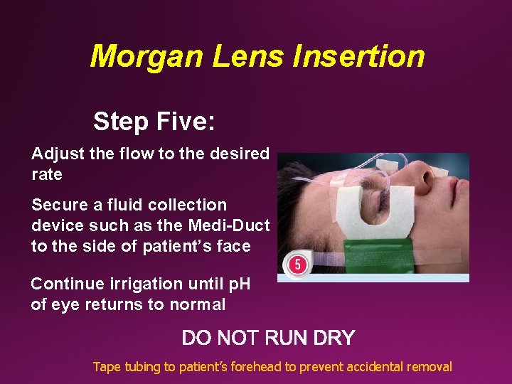 Morgan Lens Insertion Step Five: Adjust the flow to the desired rate Secure a