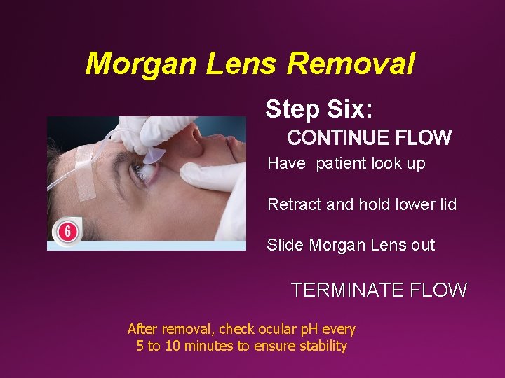 Morgan Lens Removal Step Six: Have patient look up Retract and hold lower lid