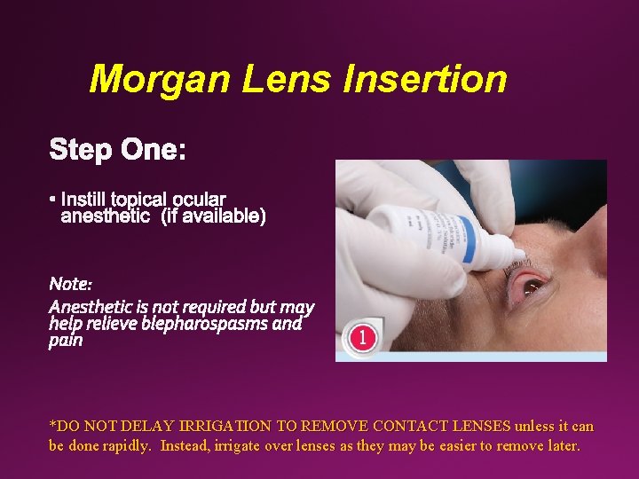 Morgan Lens Insertion *DO NOT DELAY IRRIGATION TO REMOVE CONTACT LENSES unless it can