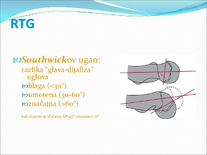 RTG Southwickov ugao: razlika “glava-dijafiza” uglova blaga (<30°) umerena (30 -60°) značajna (>60°) kod