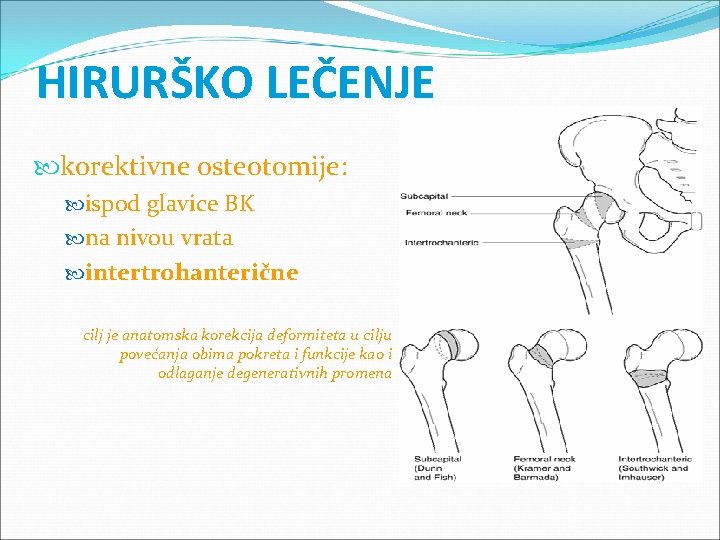 HIRURŠKO LEČENJE korektivne osteotomije: ispod glavice BK na nivou vrata intertrohanterične cilj je anatomska