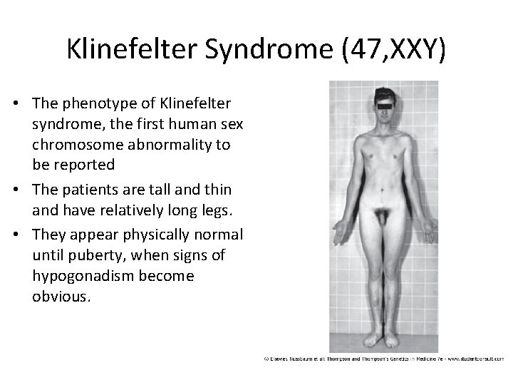 Klinefelter Syndrome (47, XXY) • The phenotype of Klinefelter syndrome, the first human sex