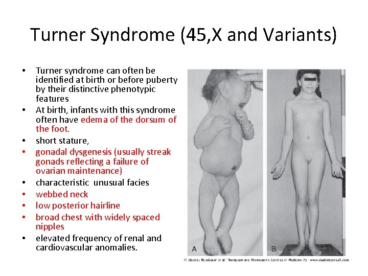 Turner Syndrome (45, X and Variants) • • • Turner syndrome can often be