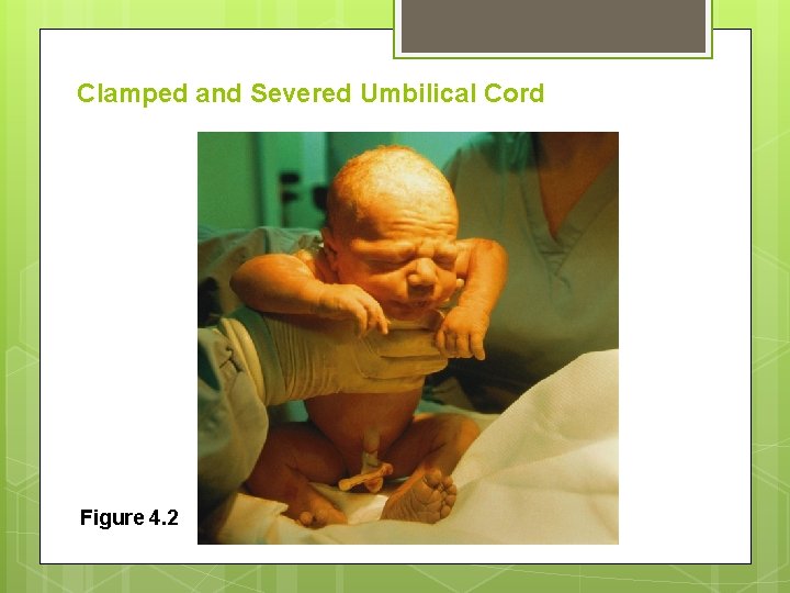 Clamped and Severed Umbilical Cord Figure 4. 2 