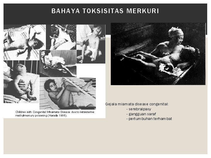 BAHAYA TOKSISITAS MERKURI Gejala miamata disease congenital: - serebralpasy - gangguan saraf - pertumbuhan