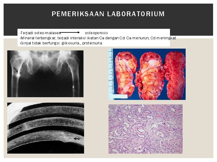 PEMERIKSAAN LABORATORIUM -Terjadi osteo-malasea osteoporosis -Mineral terbongkar, terjadi interaksi ikatan Ca dengan Cd: Ca