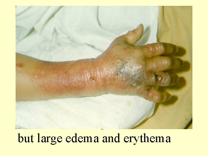 Notice small finger ulcer, but large edema and erythema 