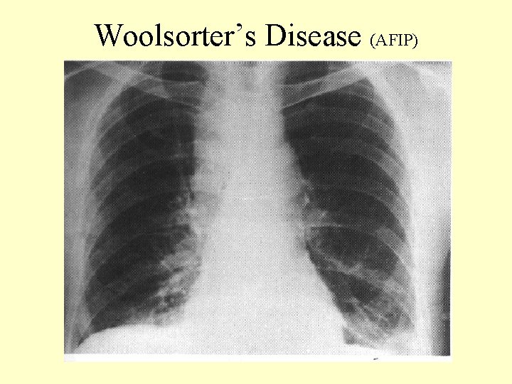 Woolsorter’s Disease (AFIP) 