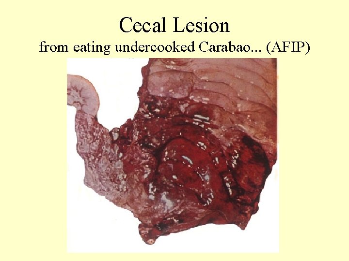 Cecal Lesion from eating undercooked Carabao. . . (AFIP) 