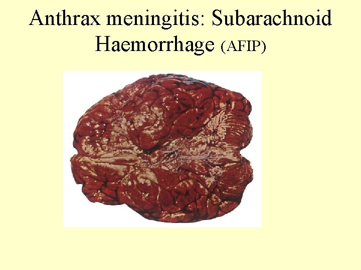 Anthrax meningitis: Subarachnoid Haemorrhage (AFIP) 