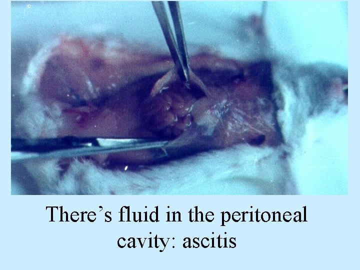 There’s fluid in the peritoneal cavity: ascitis 