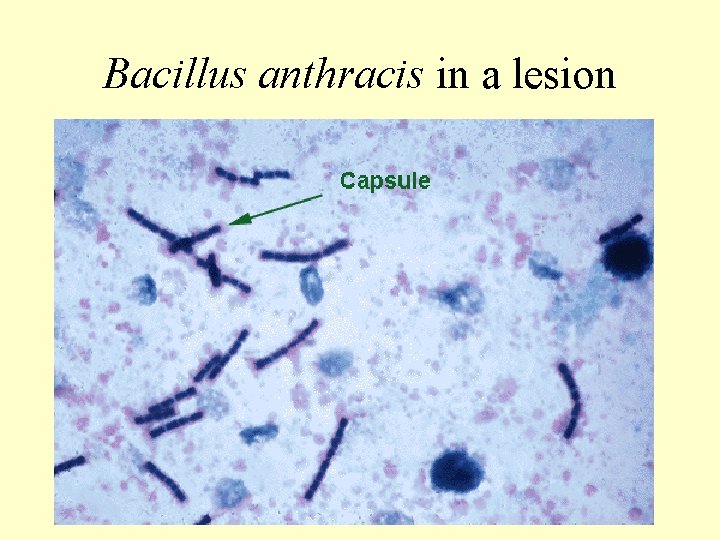 Bacillus anthracis in a lesion 