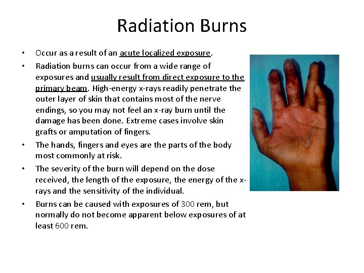 Radiation Burns • • • Occur as a result of an acute localized exposure.