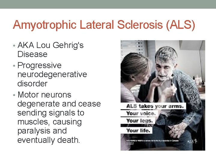 Amyotrophic Lateral Sclerosis (ALS) • AKA Lou Gehrig's Disease • Progressive neurodegenerative disorder •