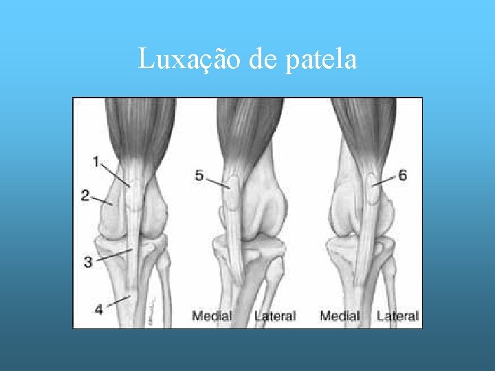 Luxação de patela 