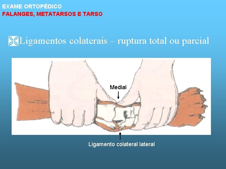 EXAME ORTOPÉDICO FALANGES, METATARSOS E TARSO Ì Ligamentos colaterais – ruptura total ou parcial