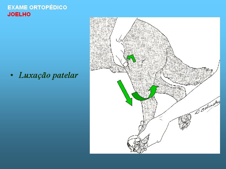 EXAME ORTOPÉDICO JOELHO • Luxação patelar 