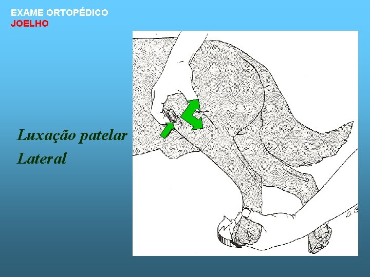 EXAME ORTOPÉDICO JOELHO Luxação patelar Lateral 