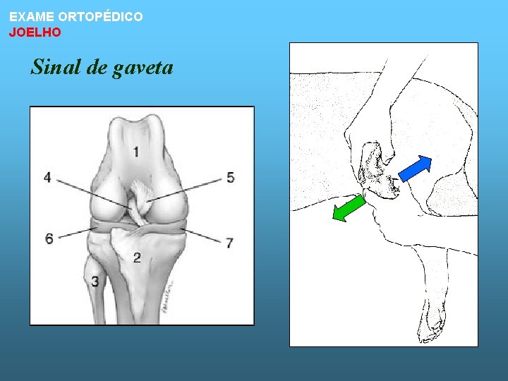 EXAME ORTOPÉDICO JOELHO Sinal de gaveta 
