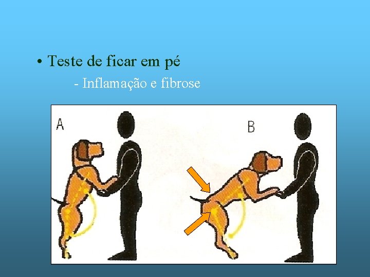  • Teste de ficar em pé - Inflamação e fibrose 