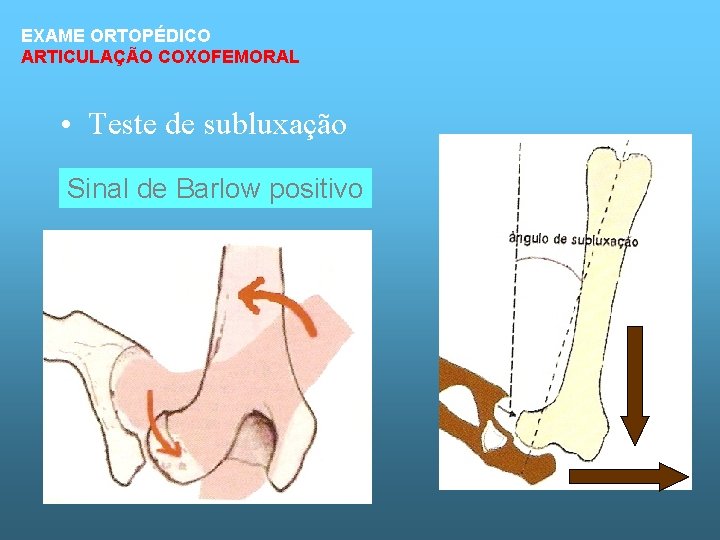 EXAME ORTOPÉDICO ARTICULAÇÃO COXOFEMORAL • Teste de subluxação Sinal de Barlow positivo 