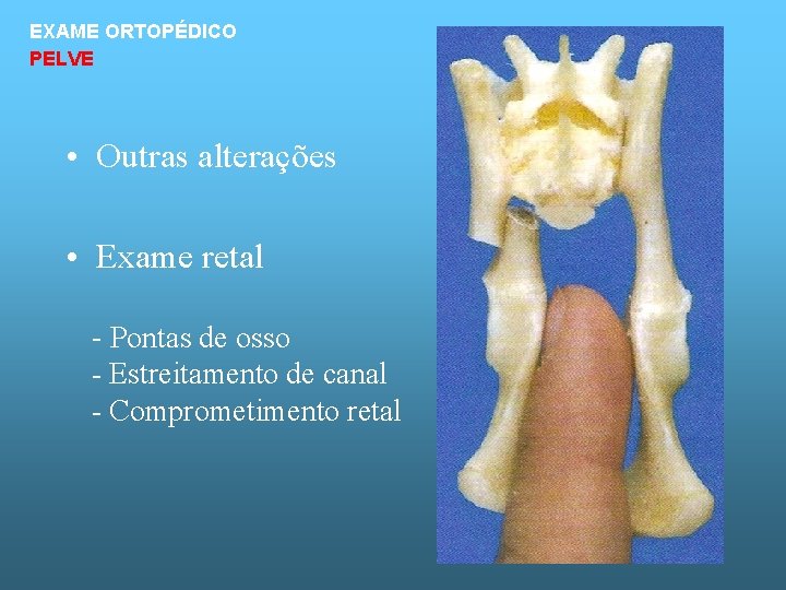 EXAME ORTOPÉDICO PELVE • Outras alterações • Exame retal - Pontas de osso -