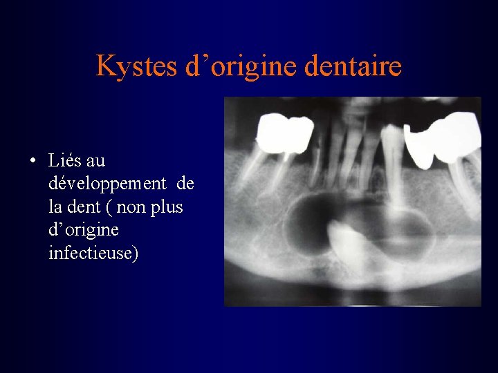 Kystes d’origine dentaire • Liés au développement de la dent ( non plus d’origine