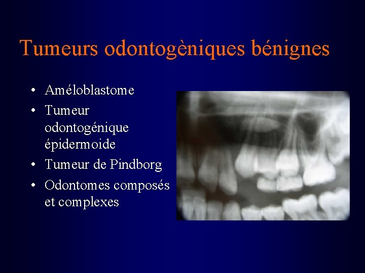 Tumeurs odontogèniques bénignes • Améloblastome • Tumeur odontogénique épidermoide • Tumeur de Pindborg •