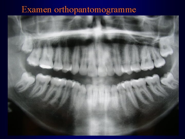 Examen orthopantomogramme 
