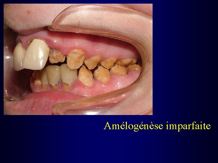 Amélogénèse imparfaite 