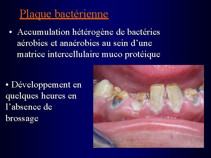 Plaque bactérienne • Accumulation hétérogène de bactéries aérobies et anaérobies au sein d’une matrice