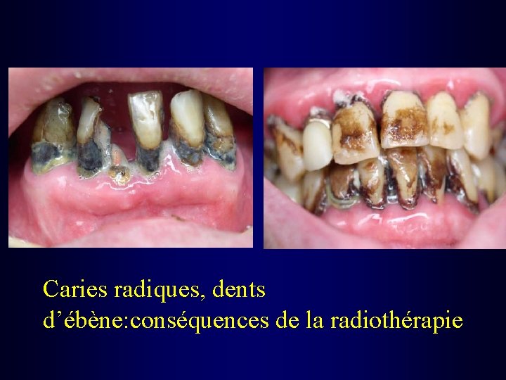 Caries radiques, dents d’ébène: conséquences de la radiothérapie 