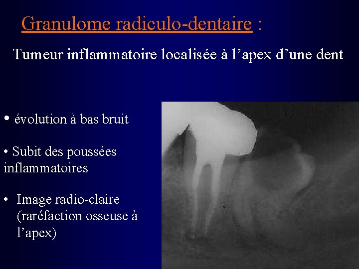 Granulome radiculo-dentaire : Tumeur inflammatoire localisée à l’apex d’une dent • évolution à bas