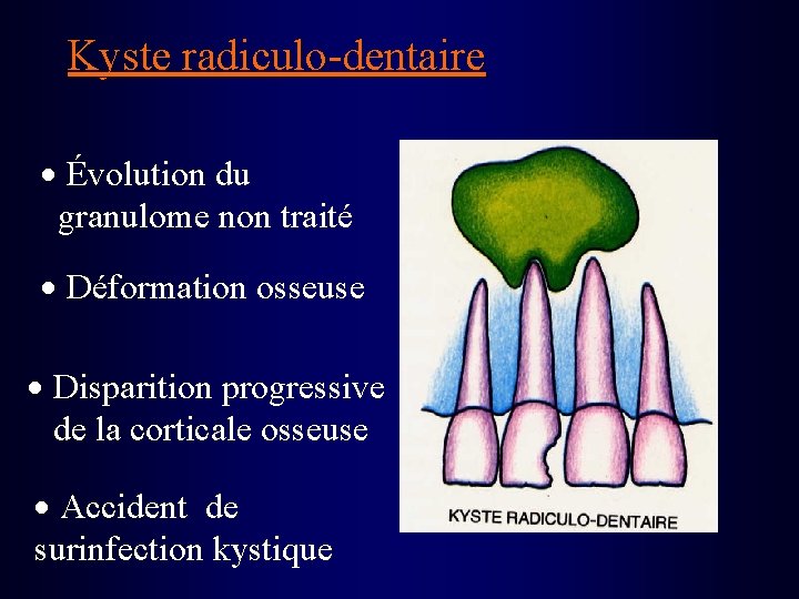 Kyste radiculo-dentaire Évolution du granulome non traité Déformation osseuse Disparition progressive de la corticale