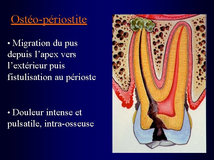 Ostéo-périostite • Migration du pus depuis l’apex vers l’extérieur puis fistulisation au périoste •