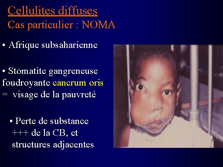 Cellulites diffuses Cas particulier : NOMA • Afrique subsaharienne • Stomatite gangreneuse foudroyante cancrum