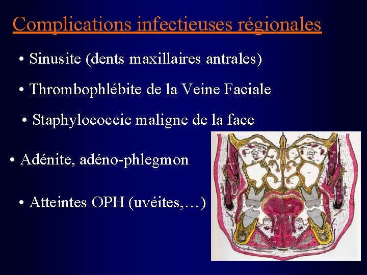 Complications infectieuses régionales • Sinusite (dents maxillaires antrales) • Thrombophlébite de la Veine Faciale