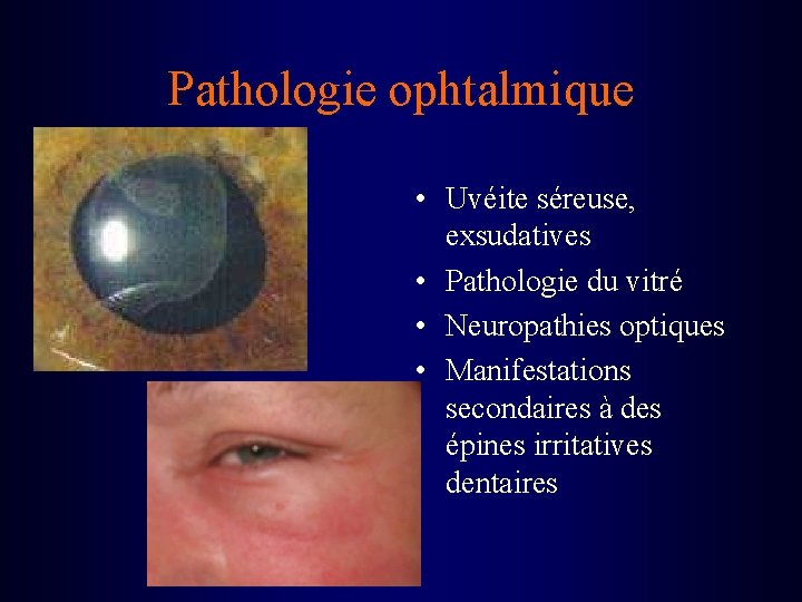 Pathologie ophtalmique • Uvéite séreuse, exsudatives • Pathologie du vitré • Neuropathies optiques •