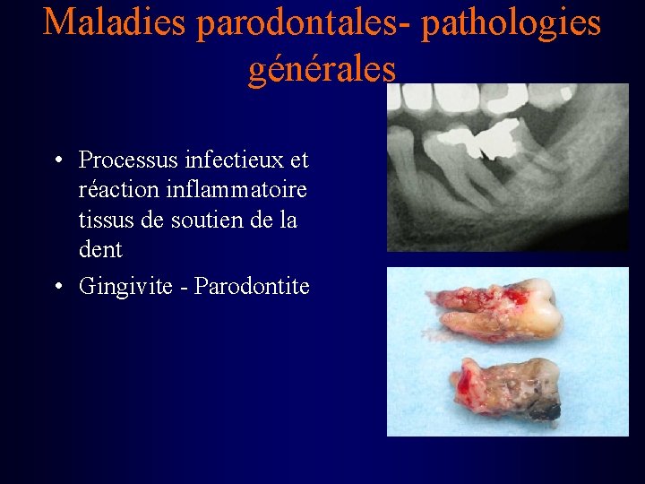 Maladies parodontales- pathologies générales • Processus infectieux et réaction inflammatoire tissus de soutien de