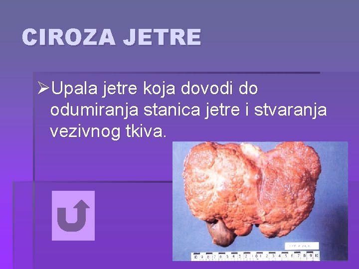 CIROZA JETRE ØUpala jetre koja dovodi do odumiranja stanica jetre i stvaranja vezivnog tkiva.
