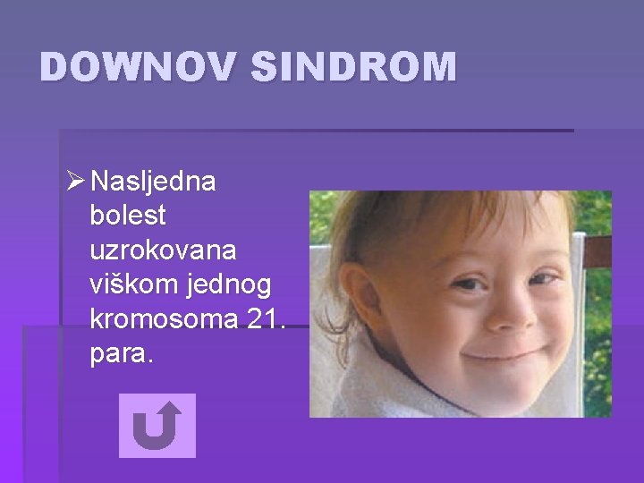 DOWNOV SINDROM Ø Nasljedna bolest uzrokovana viškom jednog kromosoma 21. para. 