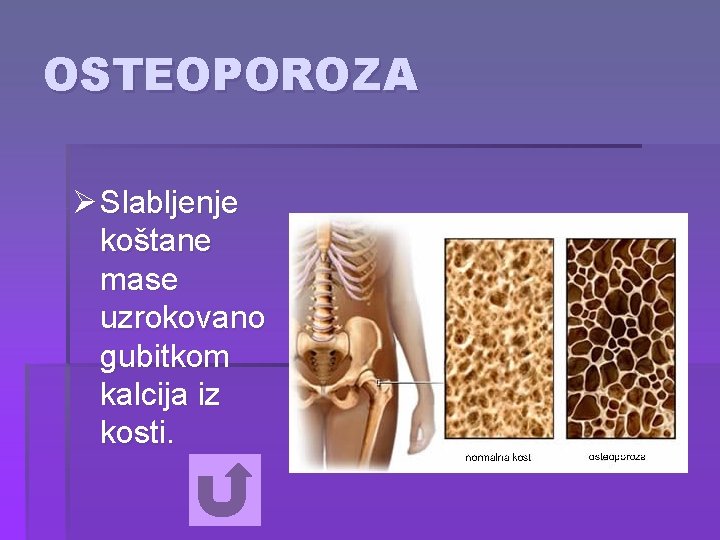 OSTEOPOROZA Ø Slabljenje koštane mase uzrokovano gubitkom kalcija iz kosti. 