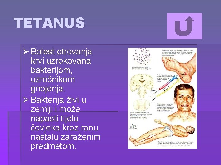 TETANUS Ø Bolest otrovanja krvi uzrokovana bakterijom, uzročnikom gnojenja. Ø Bakterija živi u zemlji