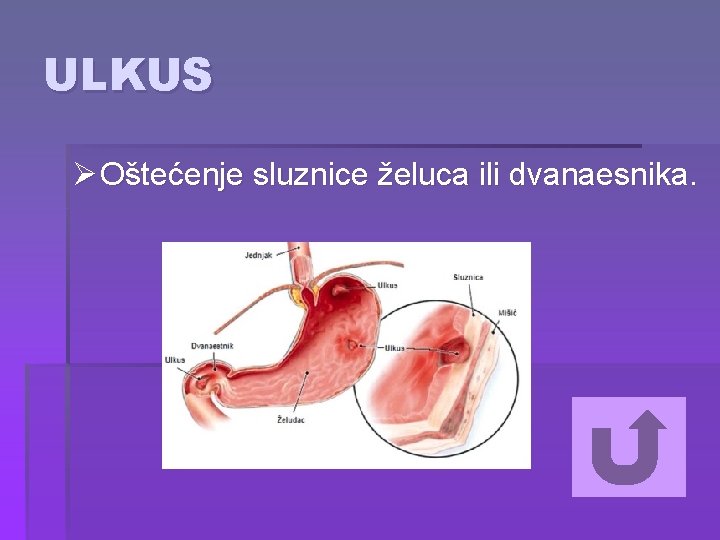 ULKUS Ø Oštećenje sluznice želuca ili dvanaesnika. 
