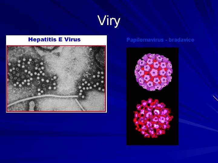Viry Papilomavirus - bradavice 
